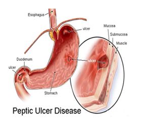 Image showing peptic ulcer disease